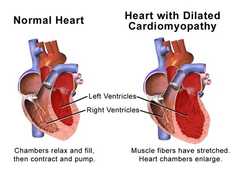 what does dilated cardiomyopathy mean